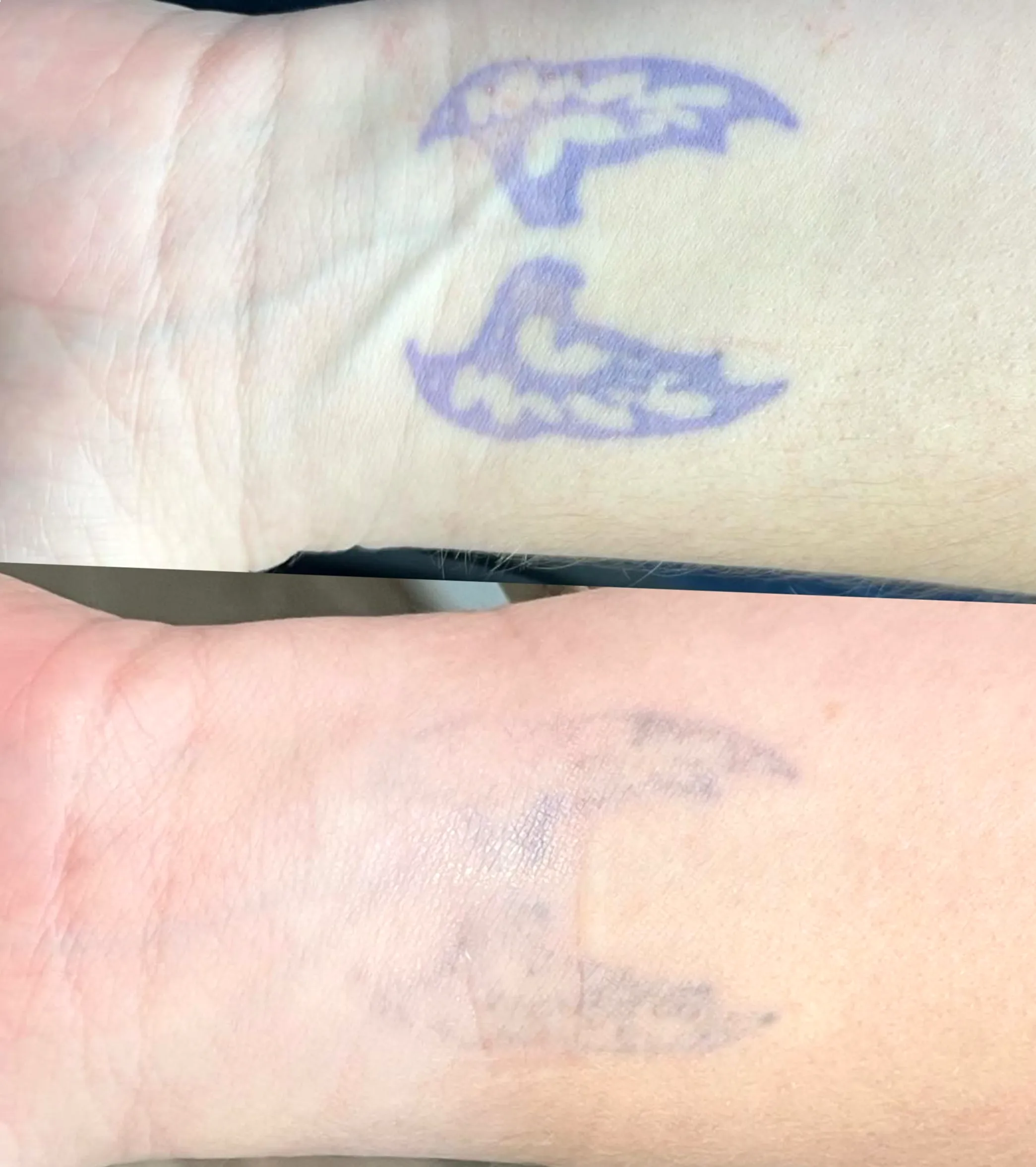 tattoo removal cost Melbourne