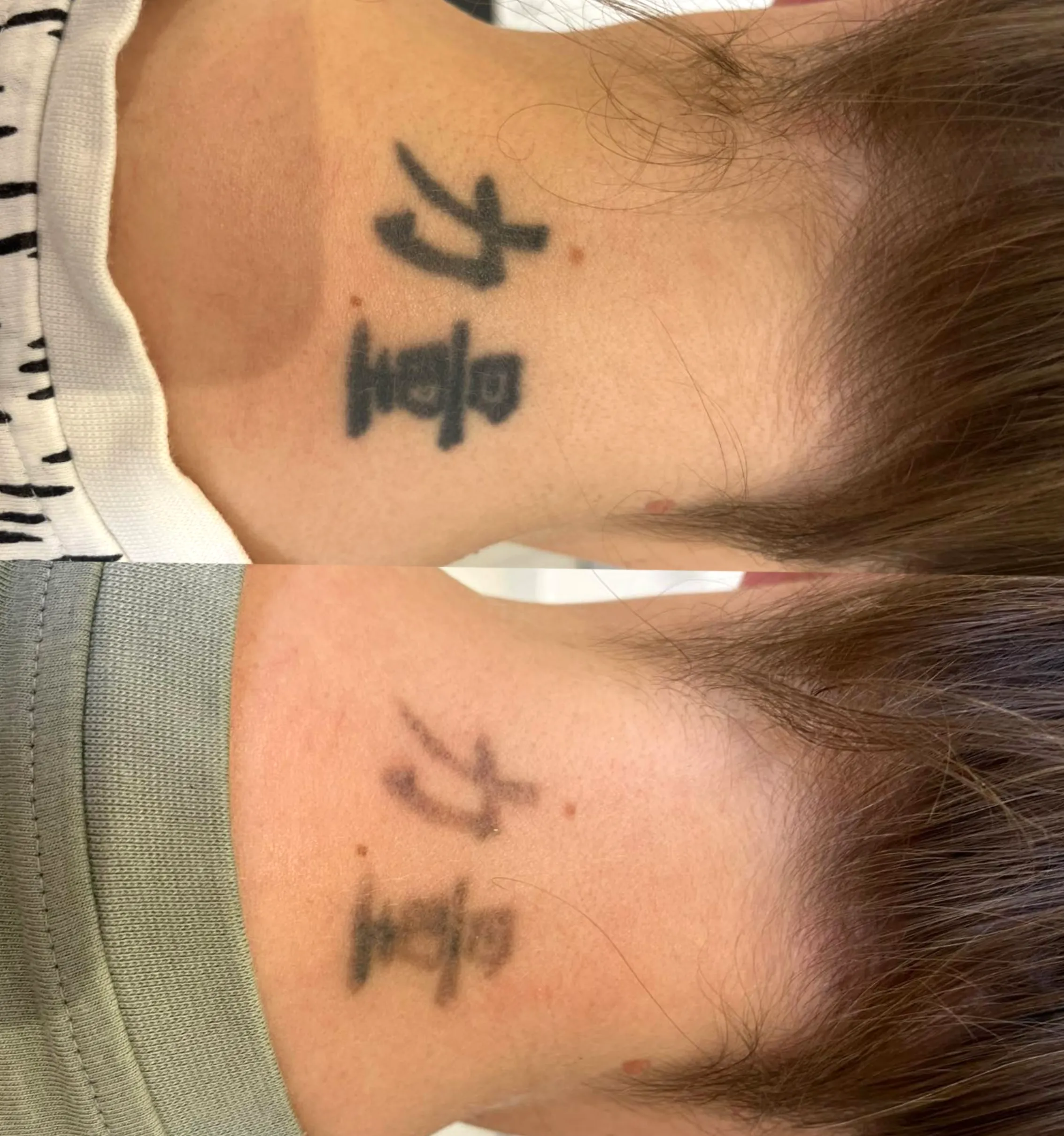 tattoo removal before and after