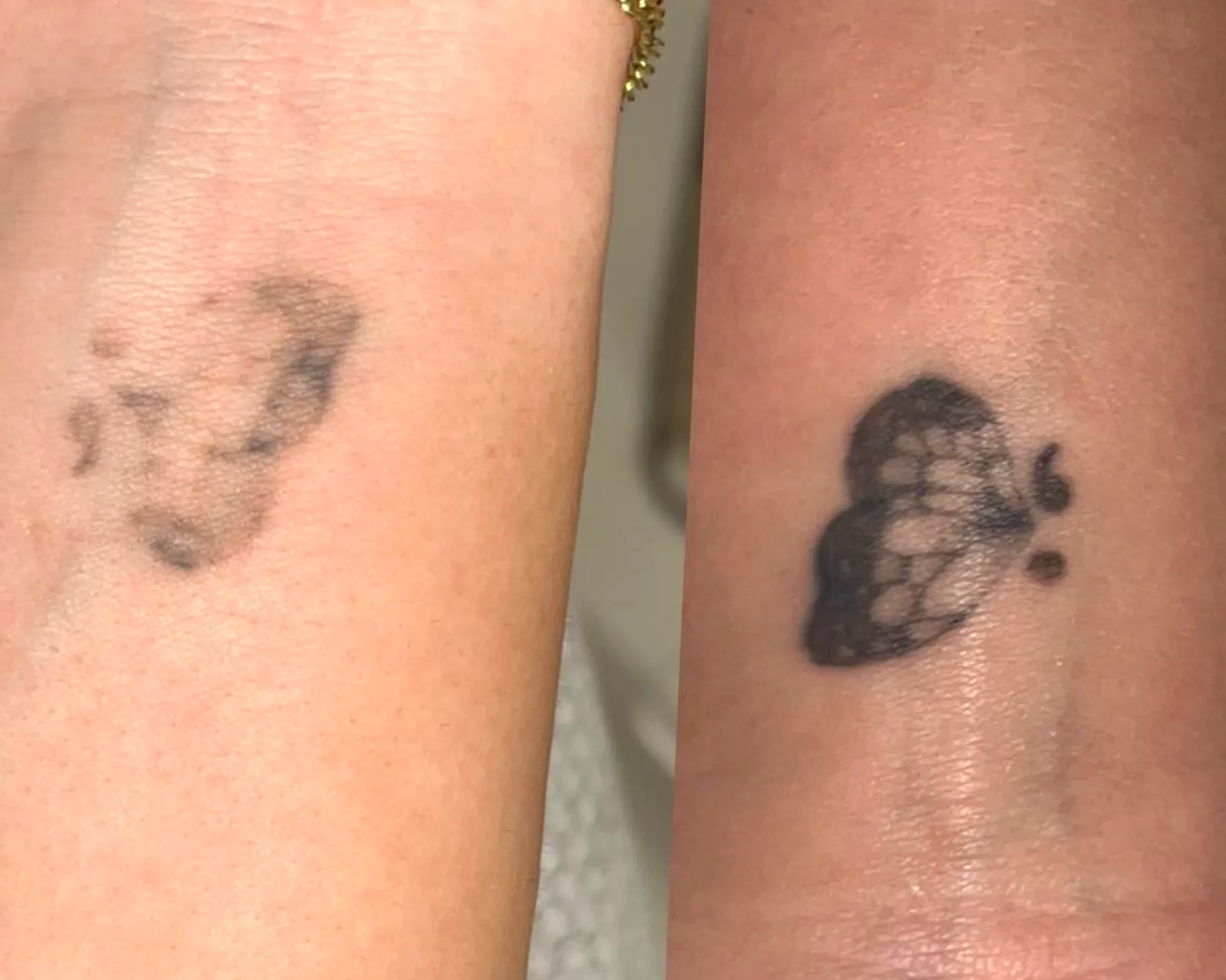 how to remove old tattoo
