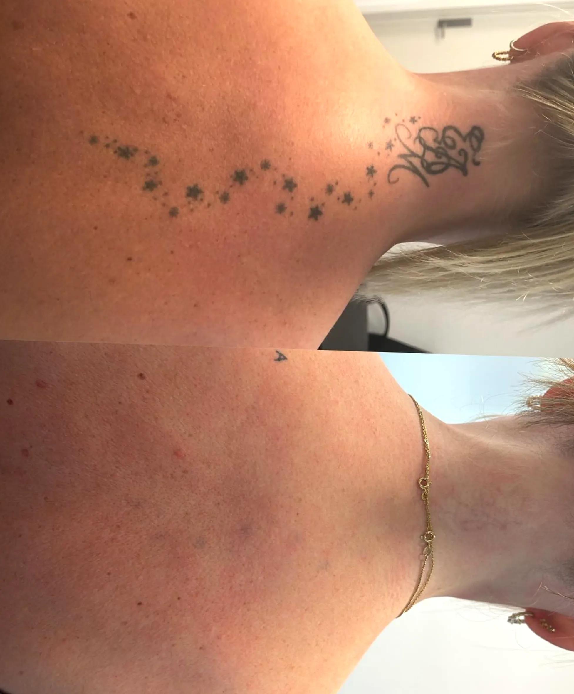 20 year old tattoo removal