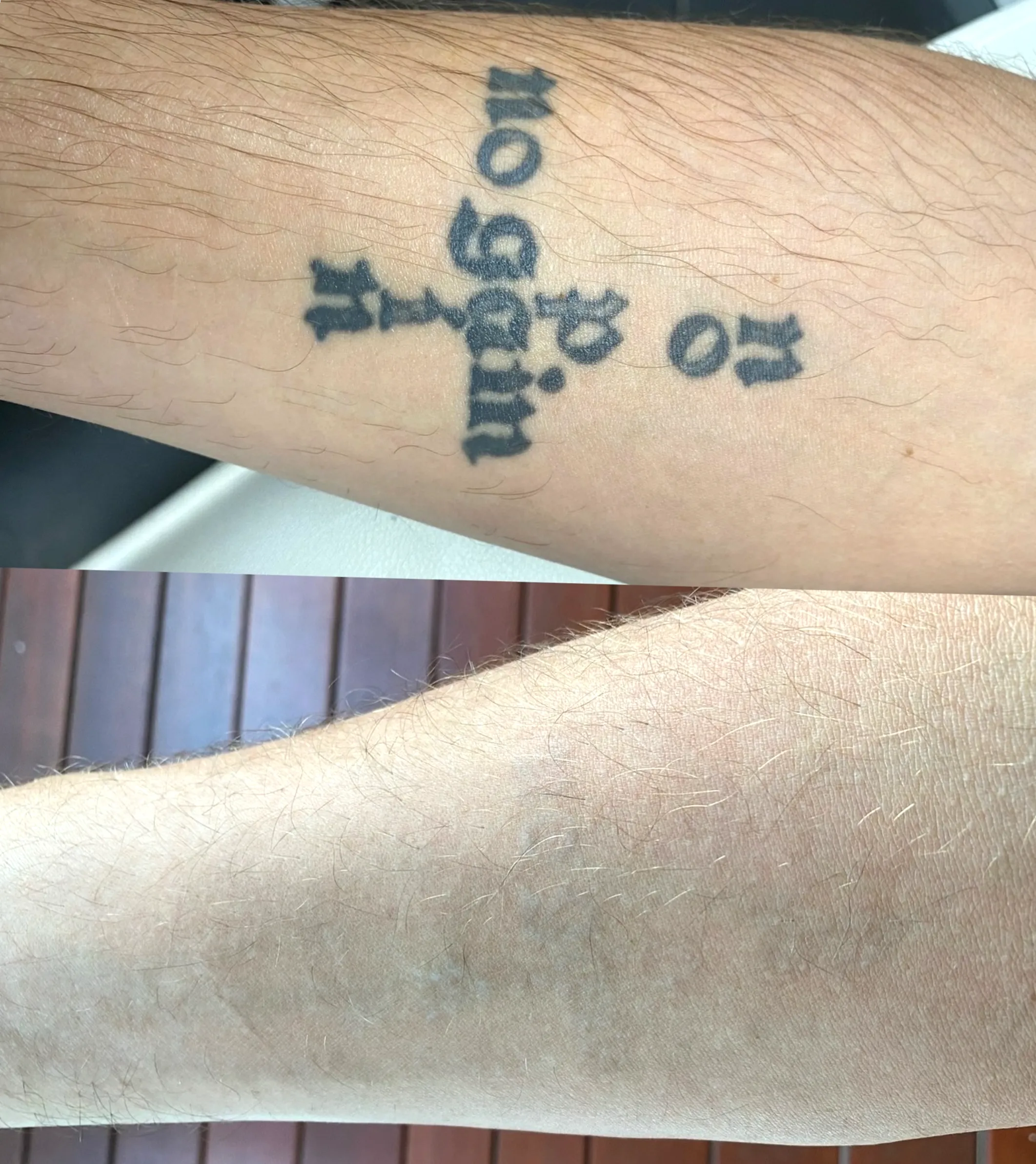 remove old tattoo