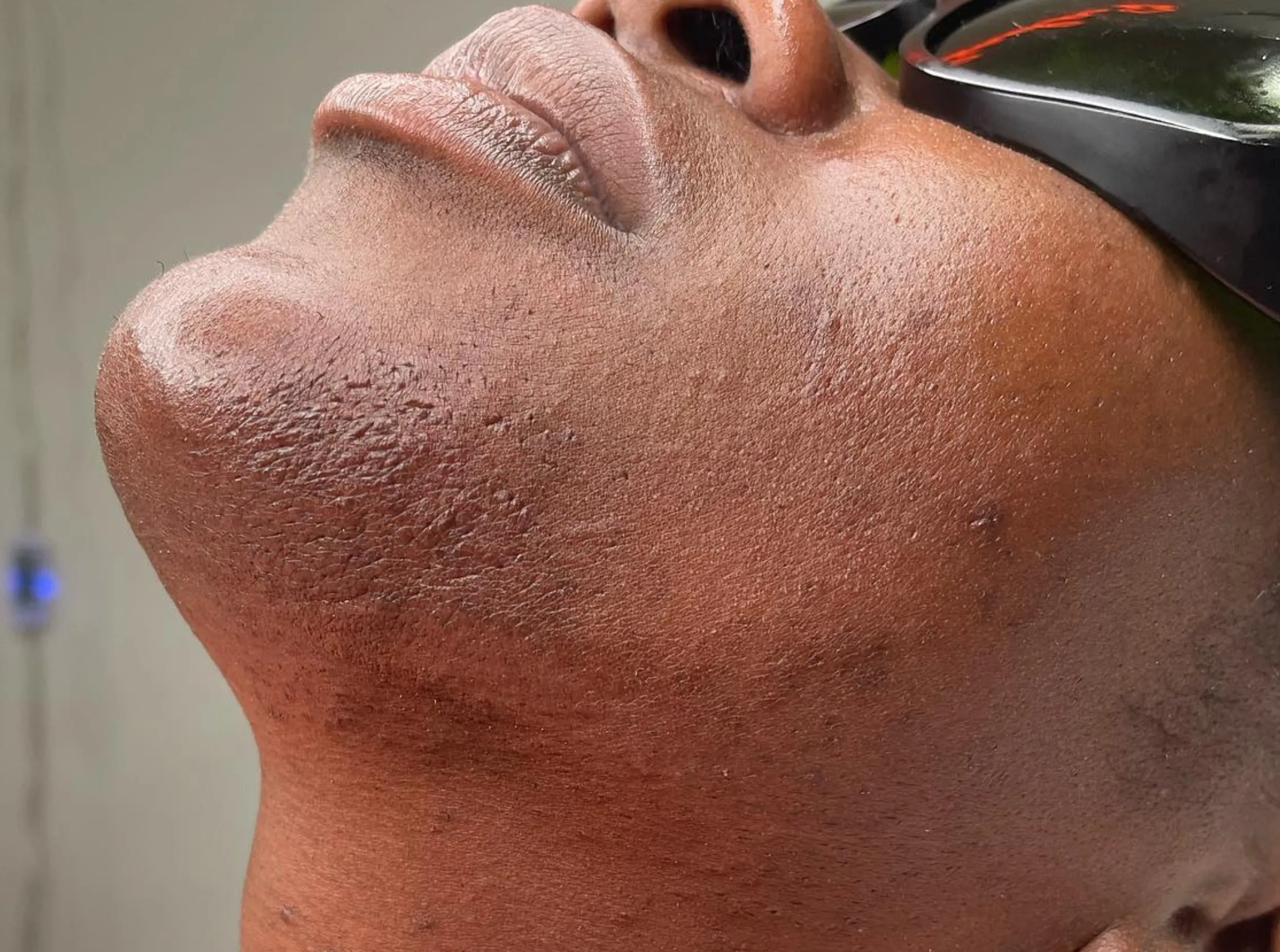 laser safety training beauty